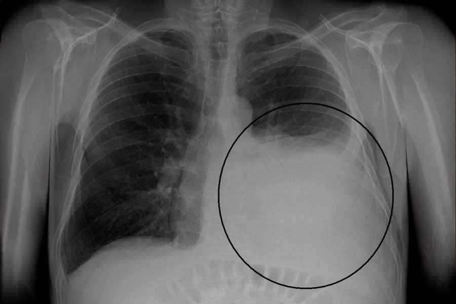 Mesotelioma Pleural: Entendiendo un Cáncer Raro