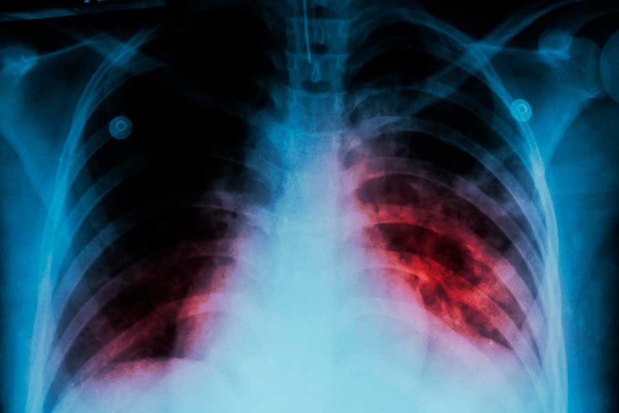 Tuberculosis Pulmonar: Un Enfoque Integral para el Tratamiento y la Prevención