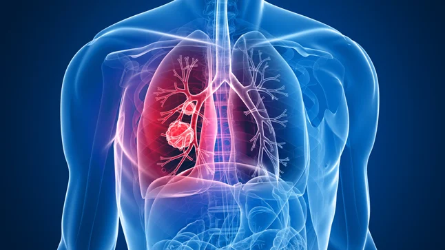 Diagnóstico y tratamiento de Cáncer de Pulmón