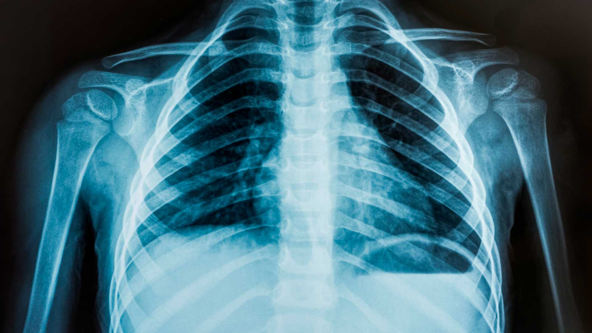 Diagnóstico Clínico de Enfermedades Broncopleuro Pulmonares