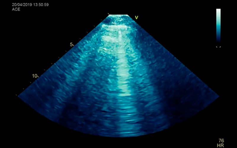 Ecografía Pleuro Pulmonar